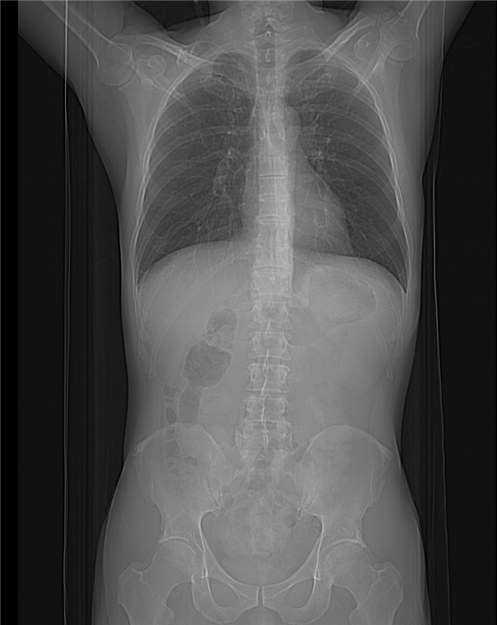 June 2024, tumor image